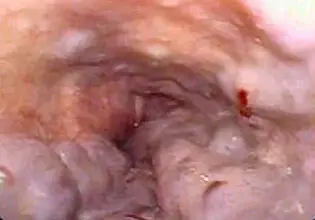 Endoscopic view of esophagus with blood