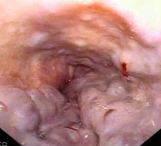 Endoscopic view of esophagus with blood
