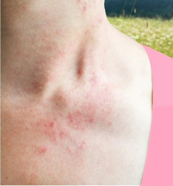 Svědivá červená vyrážka na kůži krku a hrudi.