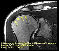 Rotator cuff tendon mri