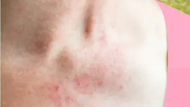 Červené podrážděné tečky na kůži krku a hrudi.