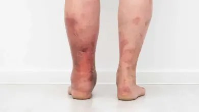 Zapálené nohy s příznaky cévního vředu na kůži.