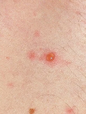 Blister s planými neštovicemi na kůži dospělého člověka.