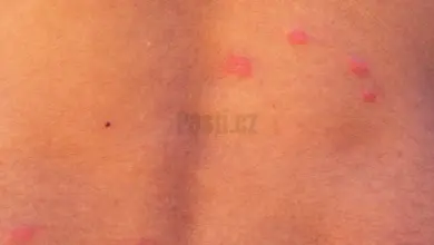 Kousnutí blech na lidské kůži – červené pupínky.
