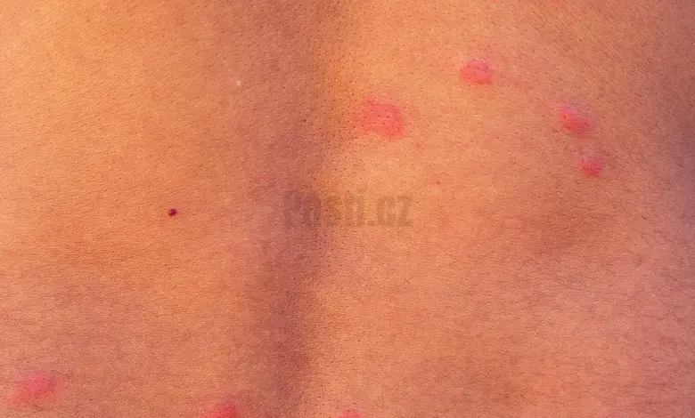 Kousnutí blech na lidské kůži – červené pupínky.