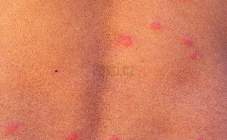 Kousnutí blech na lidské kůži - červené pupínky.